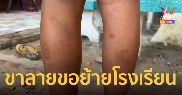 ลูกชายน่องช้ำ ถูกครูตีเพราะเล่นน้ำฝน พ่อแม่ขอย้ายลูกไปเรียนที่อื่น