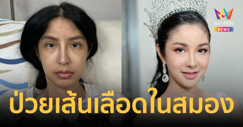 “ฟิล์ม มิสทิฟฟานี่” ตรวจพบอาการเส้นเลือดในสมองบวม ต้องเข้ารับการผ่าตัด
