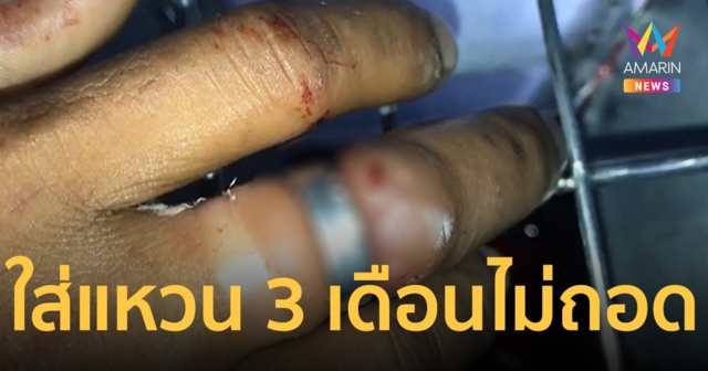 3 เดือนไม่เคยถอด! กู้ภัย เร่งช่วยเหลือหนุ่ม ใส่แหวนรัดจนนิ้วบวมเป่ง