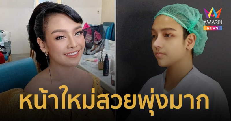 สวยพุ่งมาก! “ยุ้ย ญาติเยอะ” ทำศัลยกรรมจมูกใหม่ เสริมความปัง