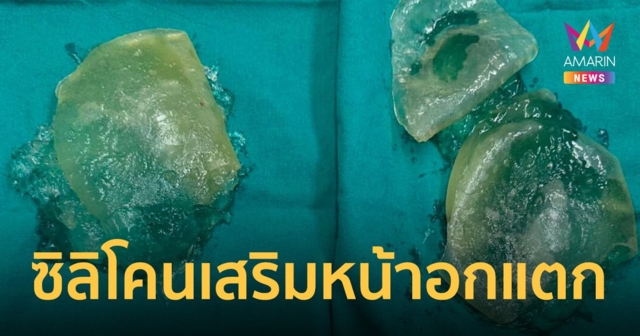 สาวแชร์ประสบการณ์ เสริมหน้าอก 20 ปี ซิลิโคนแตก แพทย์แนะควรตรวจทุก 1-2 ปี