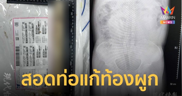 ลุงท้องผูก ใช้ท่อ PVC ยาว 30 ซม. สวนทวารหวังถ่ายคล่อง พีกหลุดเข้าไส้ทั้งดุ้น