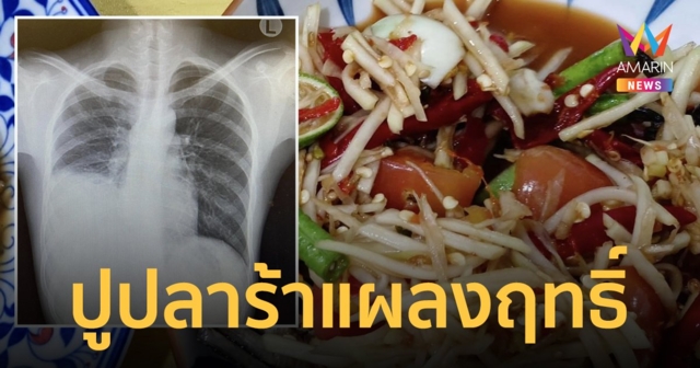 สายแซ่บนัวต้องระวัง เด็กหนุ่มกินตำปูปลาร้า เจอพยาธิไช เกิดโพรงฝีในปอด