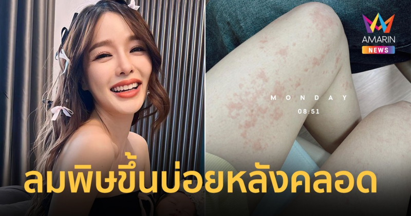 “แอร์ ภัณฑิลา” เผยภาพขาเต็มไปด้วยผื่นแดง ลมพิษขึ้นบ่อยหลังคลอด
