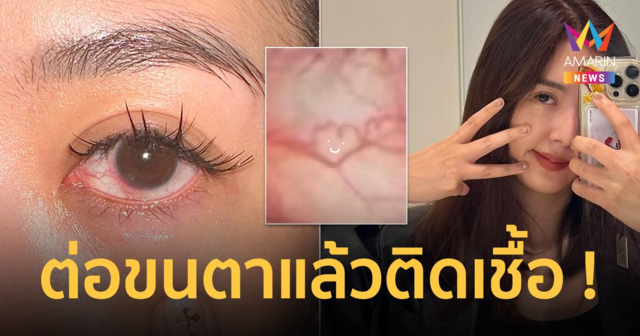“ยิปโซ” เล่าอุทาหรณ์ กระจกตาติดเชื้อจากการต่อขนตา !!