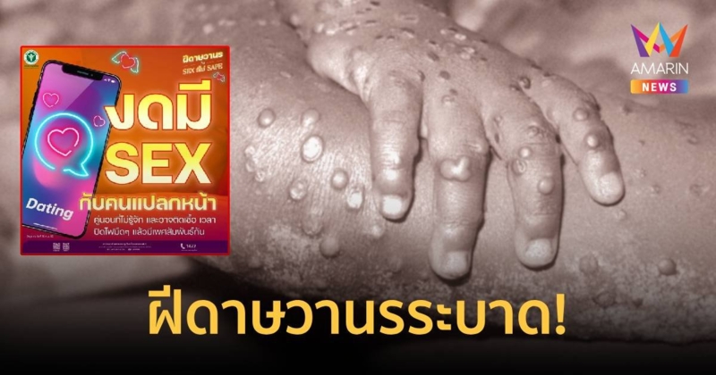 ฝีดาษวานรระบาด ติดเชื้อแล้ว 559 ราย วอน งดมีเซ็กส์กับคนแปลกหน้า