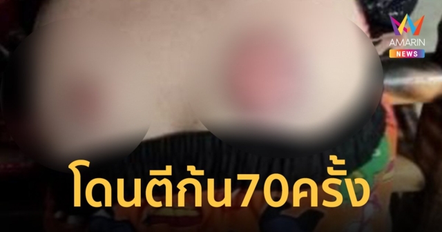 ร้องเพจดัง! เด็กป.5 โดนครูตี 70 ครั้ง อ้างทำการบ้านไม่เสร็จ