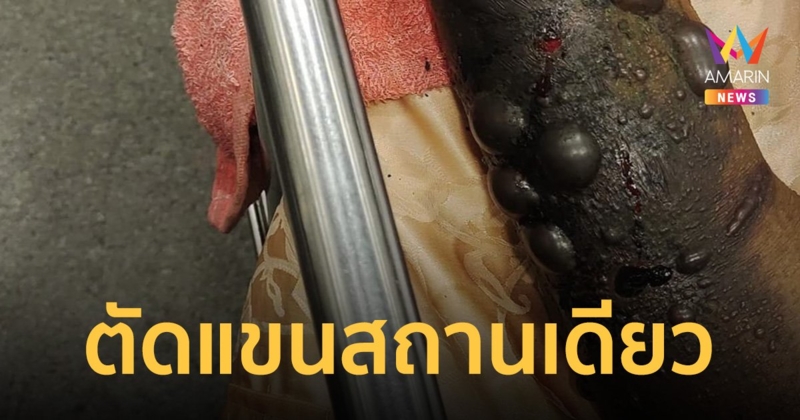 อุทาหรณ์! งูกัดแล้วไม่ไปหาหมอ ตัดแขนสถานเดียว