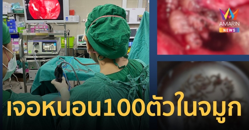 นึกว่าป่วยฝุ่น PM 2.5 หมอส่องกล้องดูจมูก ช็อก! เจอหนอน 100 ตัว