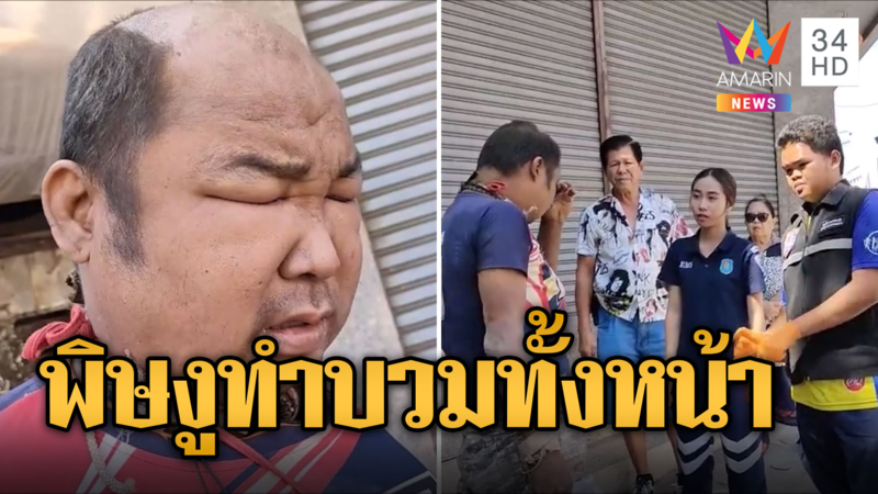 หนุ่มนอนหมดสภาพ ลั่นโดนงูพ่นพิษใส่หน้าจนบวม