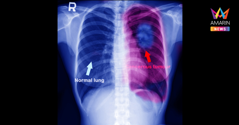 วันมะเร็งโลก 4 กุมภาพันธ์ พบสถิติคนไทยเสียชีวิตจากโรคมะเร็งวันละ 227 คน