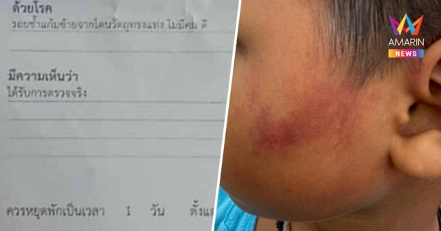 ครูสาวโหด!ใช้ฟุตเหล็กฟาดหน้าด.ช. 7 ขวบ เหตุหยิบขนมกิน