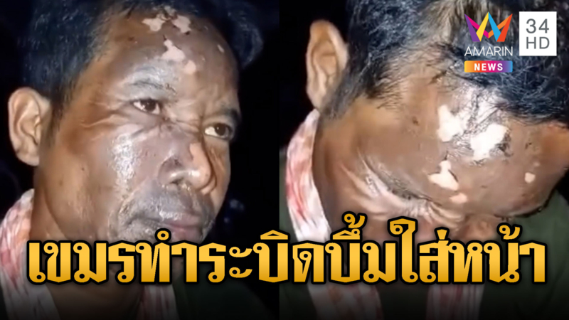 ทหารเขมรประดิษฐ์ระเบิด บึ้มใส่หน้าตัวเอง