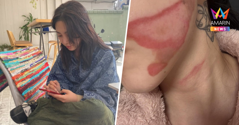 "อดีตนักร้องดัง" เสียโฉม! หน้าเป็นรอยไหม้ หลังทำหัตถการ จ่อฟ้องคลินิก