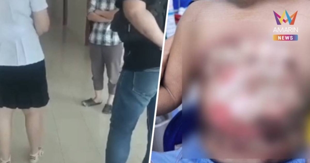 รักษาแบบใด !หมอใช้ “น้ำร้อน” ราดหน้าอก ด.ช. 3 ขวบจนเป็นแผลพุพอง