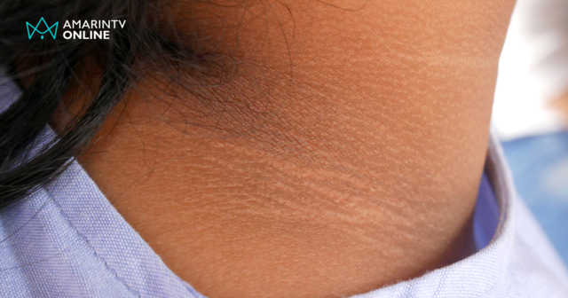 หลังคอดำ มดตอมฉี่ เป็นสัญญาณเบาหวานจริงหรือ? ระวัง! เบาหวานแฝงในอาหาร