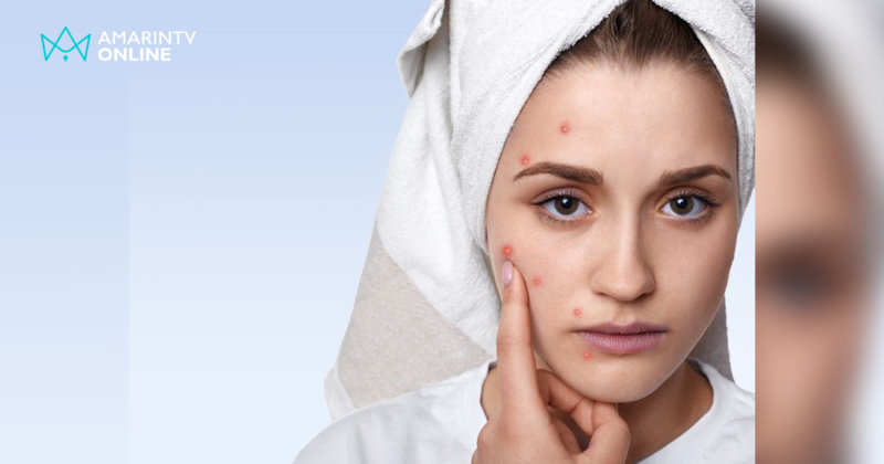 รักษาสิวอย่างถูกวิธี โดยแพทย์ผิวหนัง เห็นผลจริง ปลอดภัย