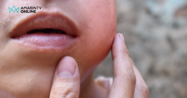 คางทูม ระบาดวัยรุ่น-วัยทำงาน หมอย้ำถ้ามี 3 อาการนี้ให้สงสัยเลยว่าเป็น