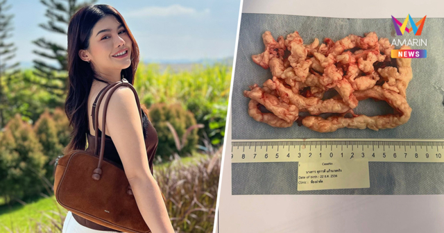 สาวแชร์อุทาหรณ์! นึกว่าอ้วนที่ไหนได้ เจอเนื้องอกใหญ่กว่ามดลูกตัวเอง