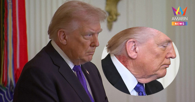 ว่อนโซเชียล! รอยแดงปริศนาที่คอ 