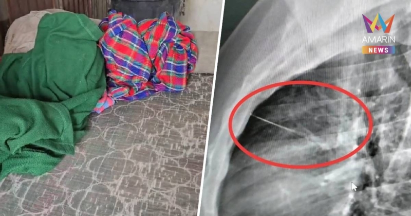 หนุ่มทิ้งตัวลงที่นอน เจอเข็มเย็บผ้าซ่อนอยู่เสียบมิดเฉียดหัวใจสาหัส