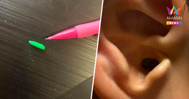 เตือนภัยใกล้ตัว! 7 ขวบเอาไส้สีไม้ยัดหูหวังโชว์เพื่อน หวิดเจาะแก้วหู