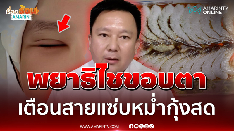 อุทาหรณ์หม่ำกุ้งแช่น้ำปลา แพทย์ย้ำอันตรายถึงขั้นตาบอดหากรักษาไม่ทัน