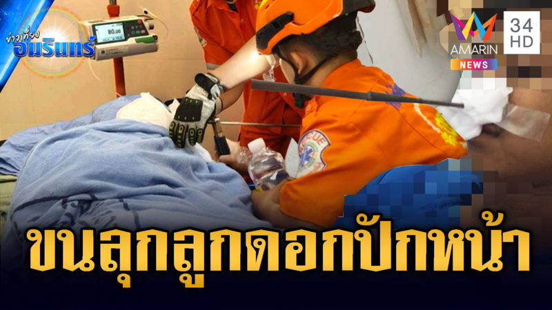 พี่น้องทะเลาะกันโหด ลูกดอกปักใบหน้า