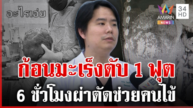 ก้อนมะเร็งตับใหญ่กว่าไม้บรรทัด โชคดีไม่ลุกลามสามารถผ่าตัดได้ 