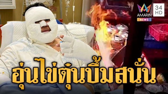 อุ่นไข่ตุ๋นบึ้มสนั่นครัว ไฟลวกหน้าเจ้าของเป็นมัมมี่