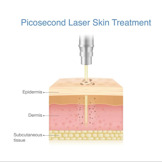 Pico Laser คืออะไร