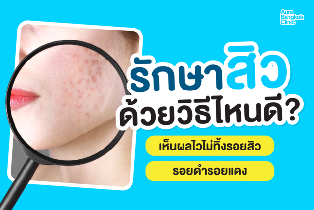 รักษาสิว