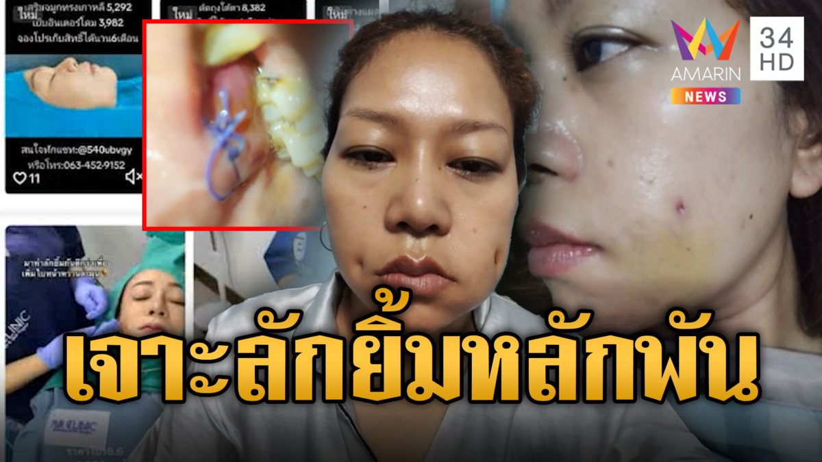 อุทาหรณ์ สาวทำศัลยกรรมลักยิ้ม 2 ด.เลือดออกไม่หยุด