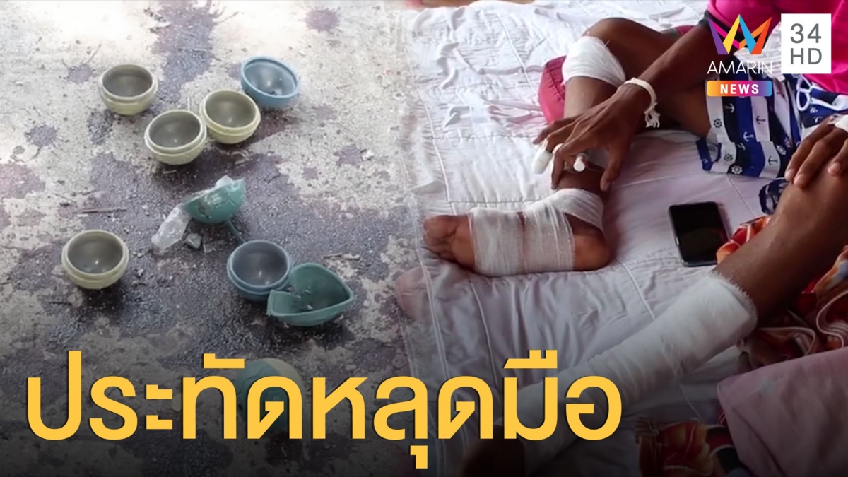 ก๊วนเด็กเล่นประทัด แต่หลุดมือระเบิดใส่ตัวเจ็บหนัก 3 ราย