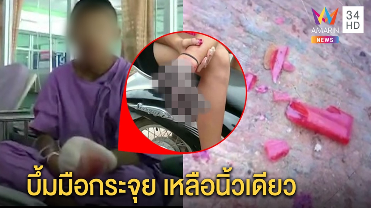 อุทาหรณ์! เด็ก 12 จุดประทัดเล่นแต่พลาดบึ้มใส่มือกระจุย เหลือแค่นิ้วก้อย