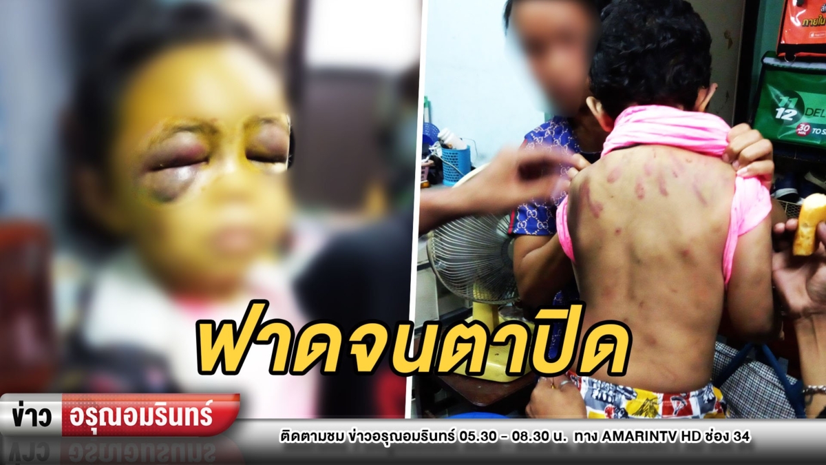 เร่งล่าแม่ชาวเมียนมา ทำร้ายลูก 5 ขวบหน้าบวมเป่ง