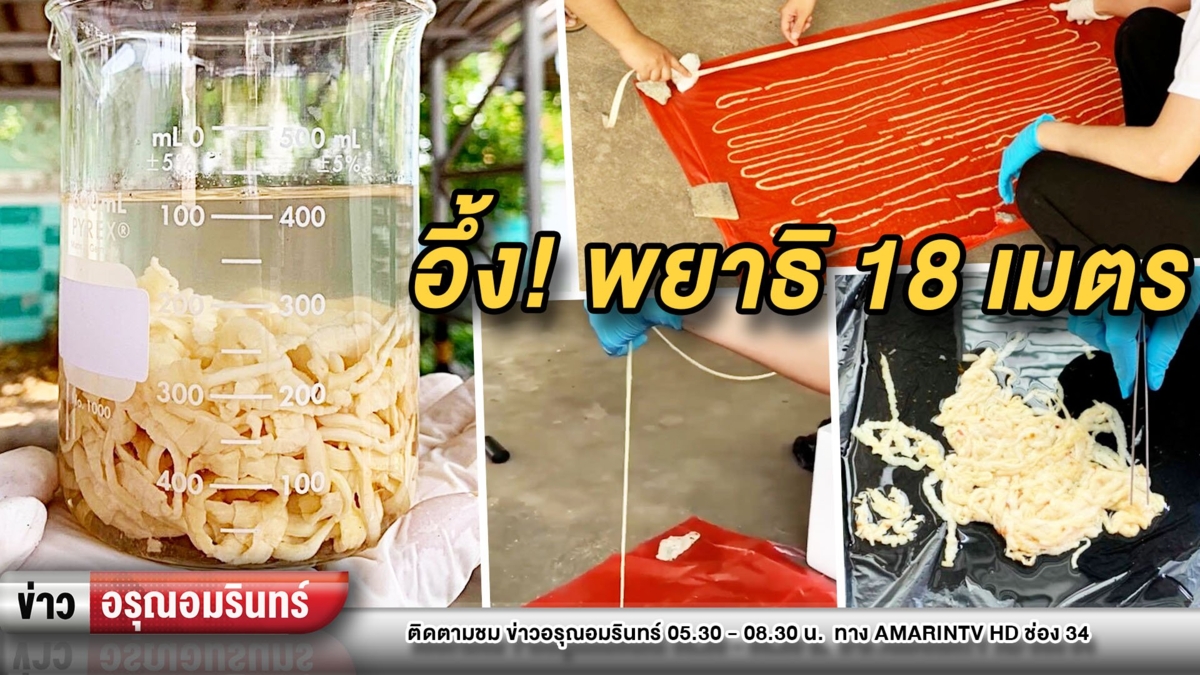 ทุบสถิติ 50 ปี! เจอพยาธิยาว 18 เมตรในตัวคน ทำเอาขนลุก