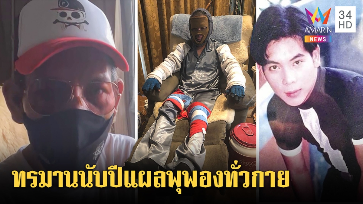 'ผี ไฮแจ็ค'ไอดอล90 ป่วยหนักผิวหนังพุพันผ้าซับน้ำเหลือง2ปี เผยยึดธรรมะเหนี่ยวใจ