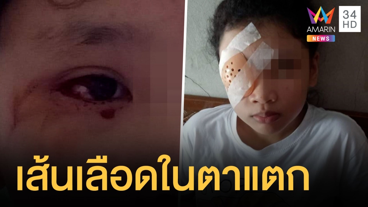 แม่ช็อก ลูกเรียนออนไลน์จนเส้นเลือดในตาแตก