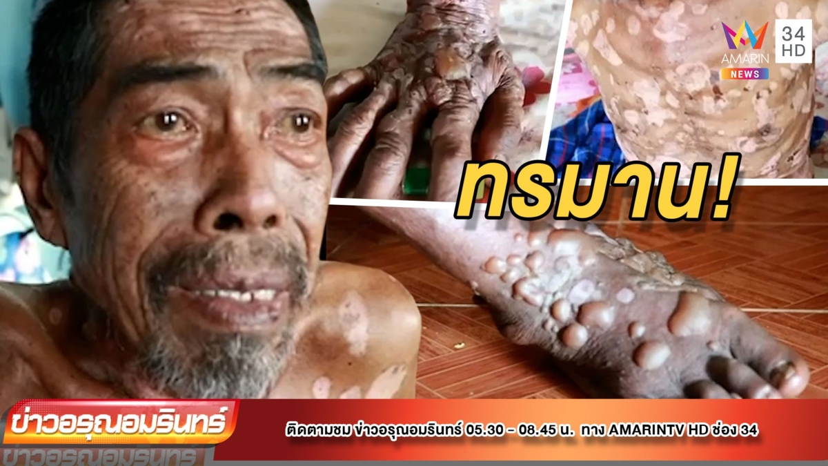 วอนช่วยลุง 62 ป่วยโรคตุ่มน้ำพองสุดทรมาน