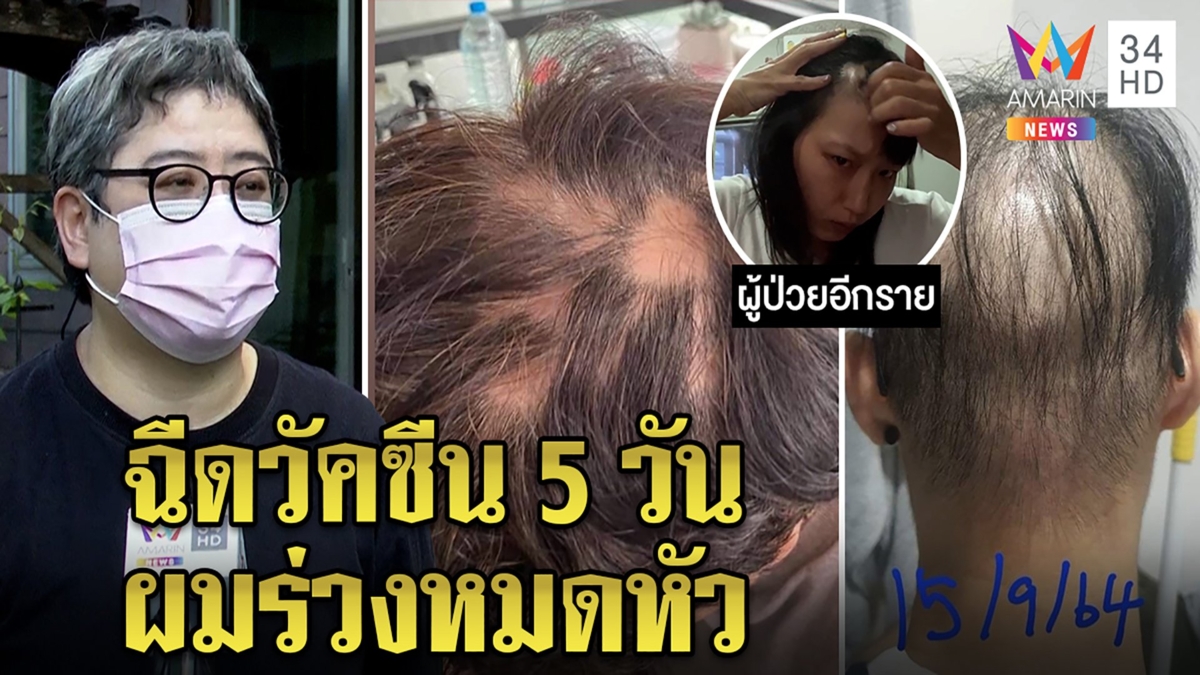 โผล่อีก! สาวฉีดวัคซีนโควิดผมร่วงหมดหัว ช้ำซื้อยากดภูมินับหมื่นไร้หน่วยงานสนใจ