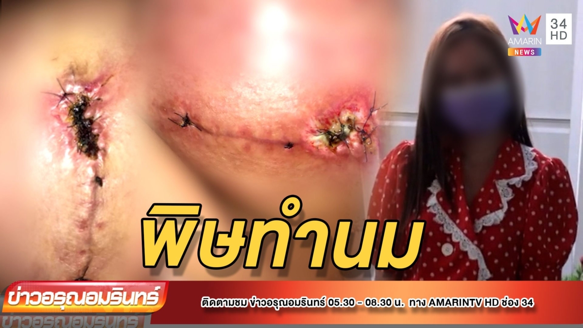 ดับฝันพริตตี้ เสริมหน้าอกเน่า-หัวนมไร้ความรู้สึก