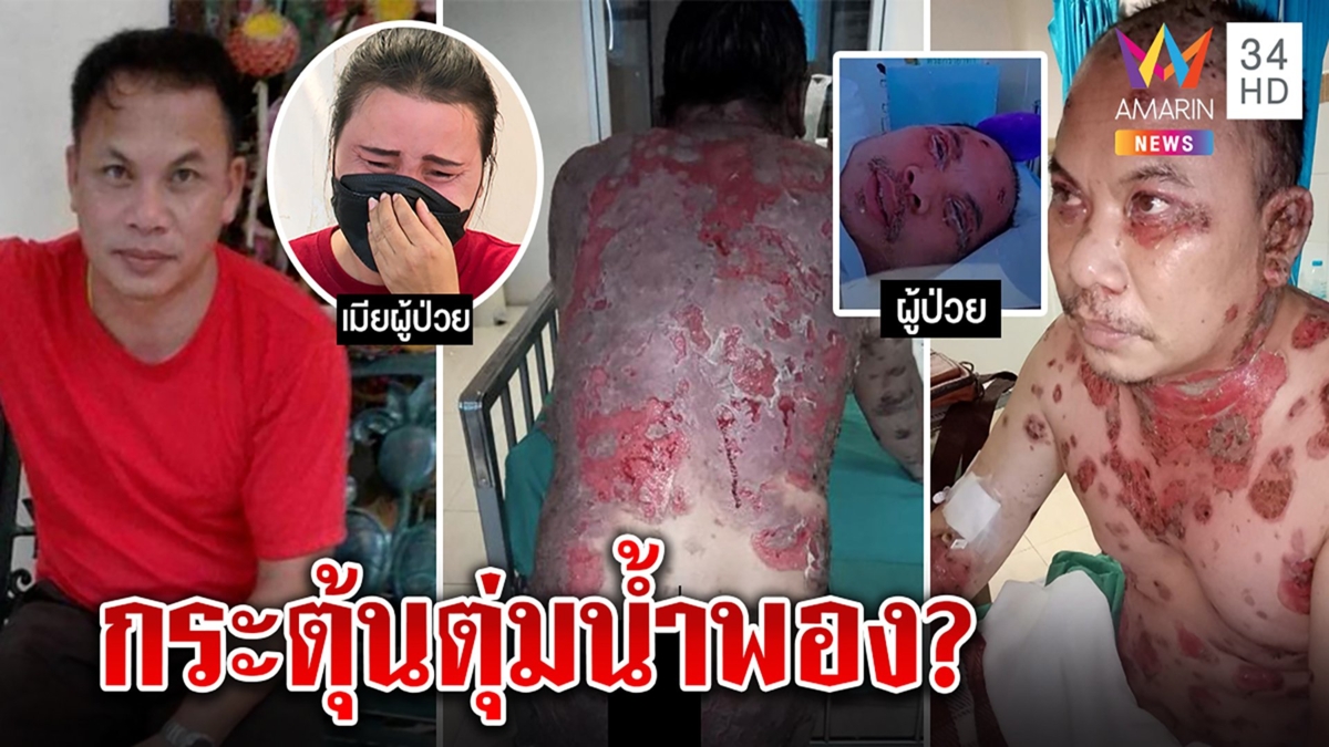 ผงะตุ่มน้ำพองลามทั่วตัว หนุ่มโฮเพิ่งฉีดวัคซีนก่อนวิกฤต หวั่นลูกเมียอดไร้เสาหลัก
