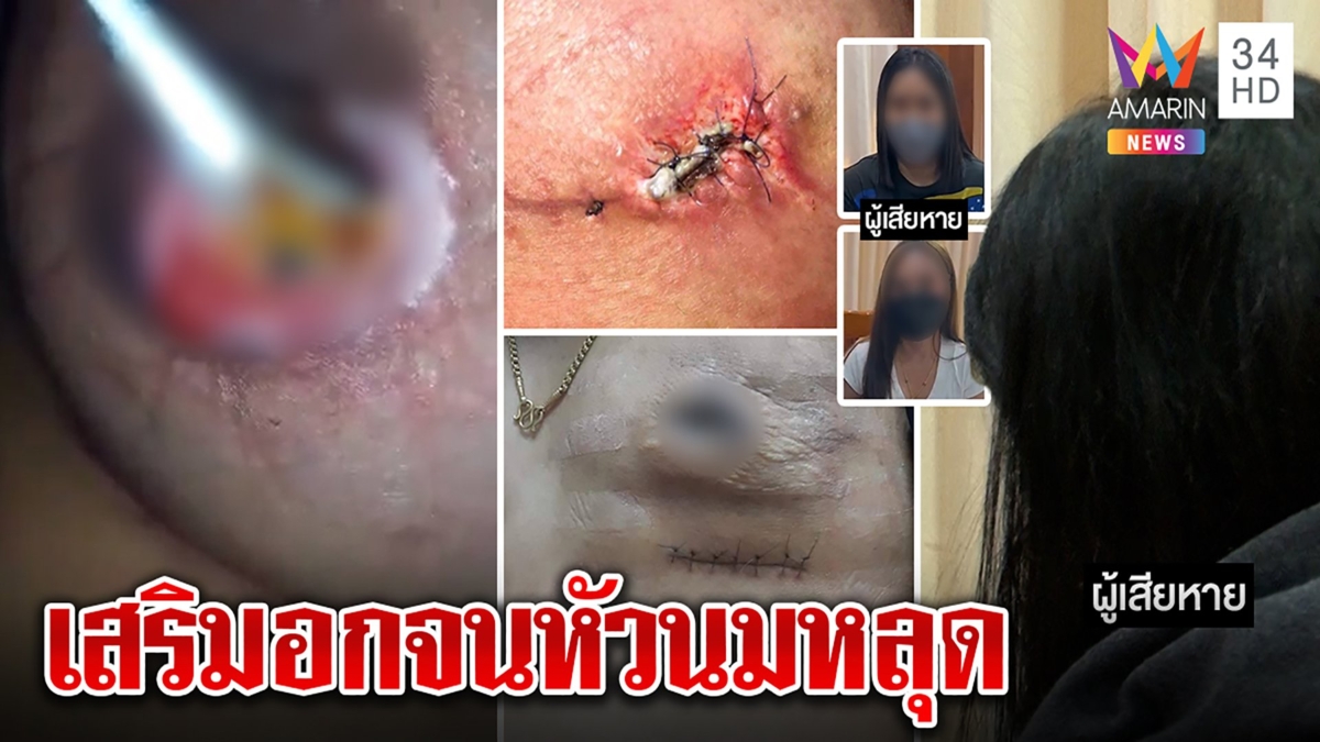 3 สาวสยองหัวนมหลุด ต้องนั่งเช็ดหนอง หมอผ่าอกไม่เยียวยา
