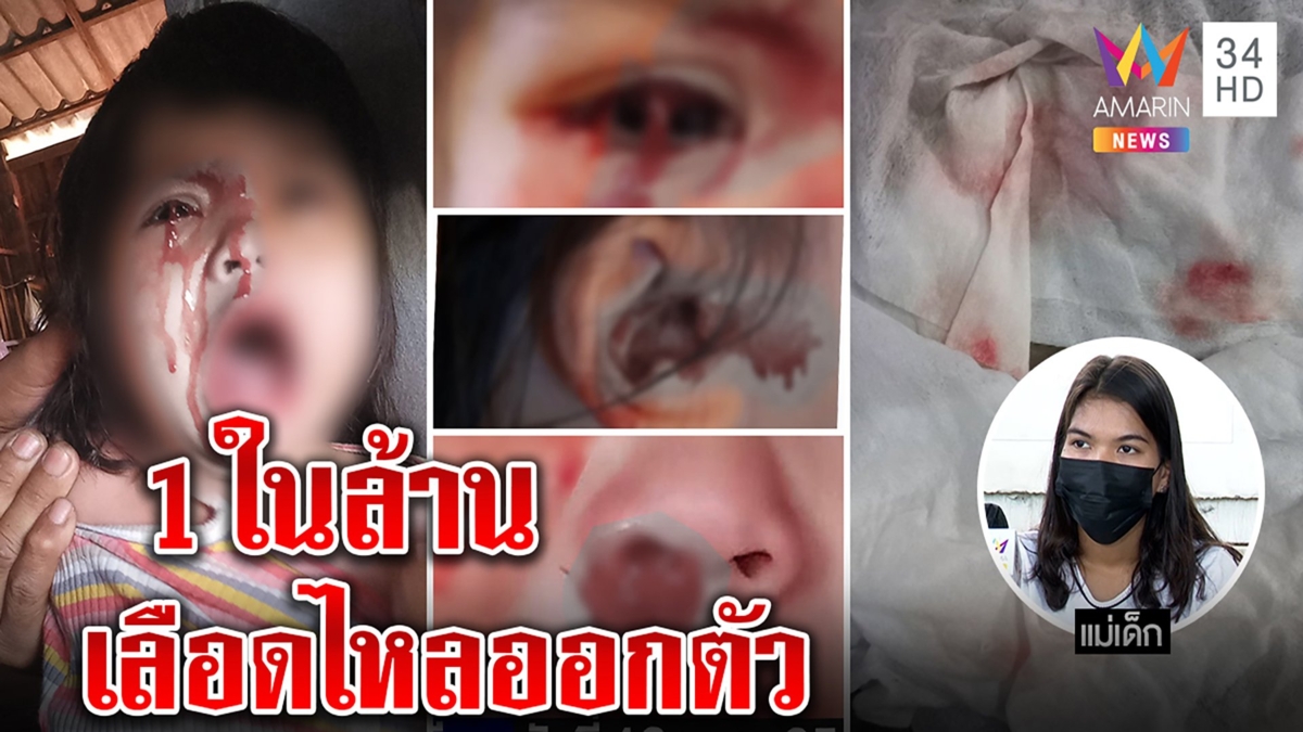 แม่ช็อก ลูกขวบเศษเลือดปริศนาไหลออกทวาร โต้จัดฉากขอเงิน หมอชี้โอกาสป่วย 1 ในล้าน