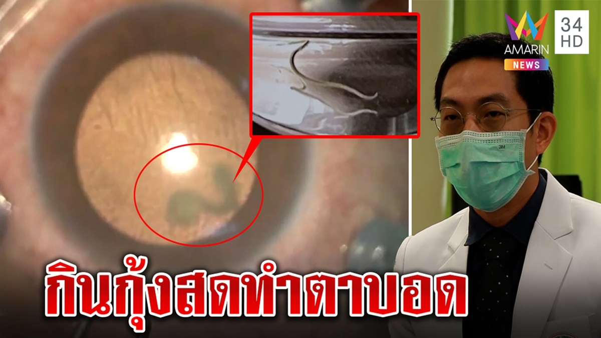 หนึ่งในล้าน! กินกุ้งแช่น้ำปลาพยาธิไชตาบอด หมอผ่านับชั่วโมงช่วยชีวิต