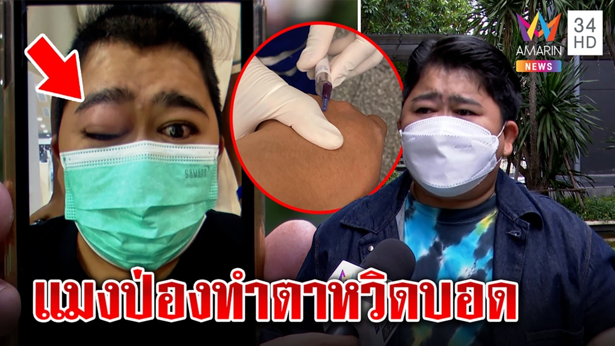 โก๊ะตี๋หวิดตาบอด กินแมงป่อง 3 ตัวแพ้ทำตาบวม หมอฉีดเข้าเส้นถึงรอด