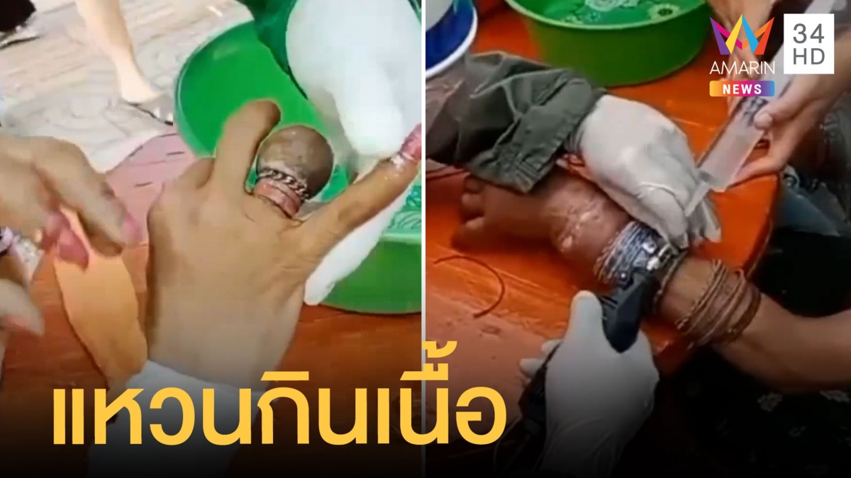กู้ภัยช่วยตัดแหวนกินเนื้อติดนิ้ว 20 วง กำไล 50 วงทำเกือบเน่า