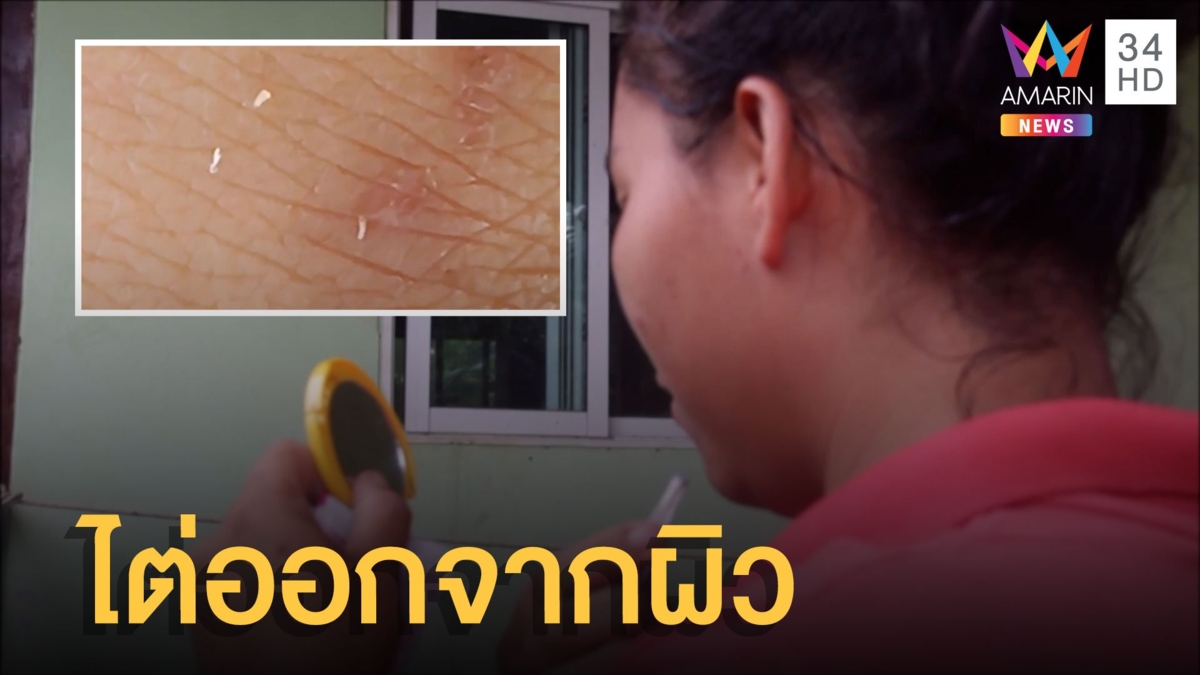 สุดช็อก ตัวประหลาดคล้ายหนอนไต่ออกจากผิวหนัง