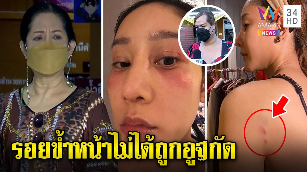 วุ่นแล้วแม่พูดเองมือถือแตงโมอยู่ที่เดชา ฮิปโปรู้แผลช้ำมีที่มางงหน้าน่วมเกิดอะไร